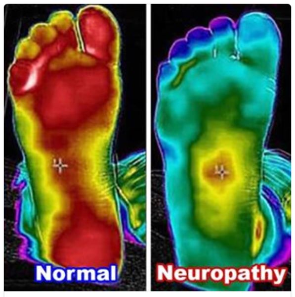 thermal scan for neuropathy